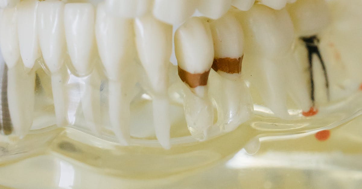 Detailed close-up of a dental model showcasing implants, fillings, and orthodontic features.